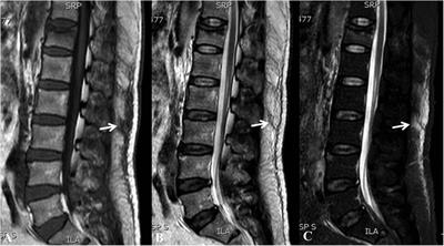 Effect of thoracolumbar fascia injury on reported outcomes after percutaneous vertebroplasty